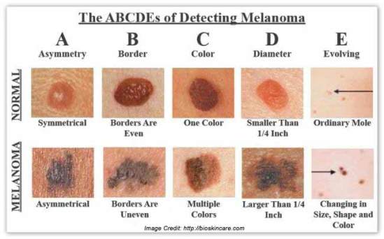 melanoma-cancer-details